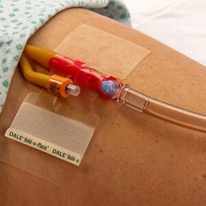 Dale Katheter fixatiepleister